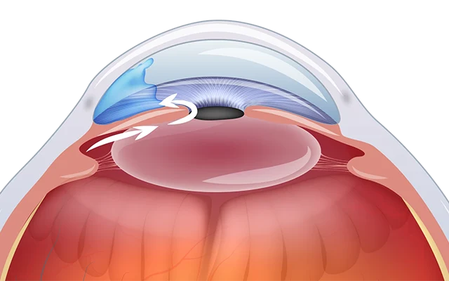 Glaukom Symptome: Glaukom Auge